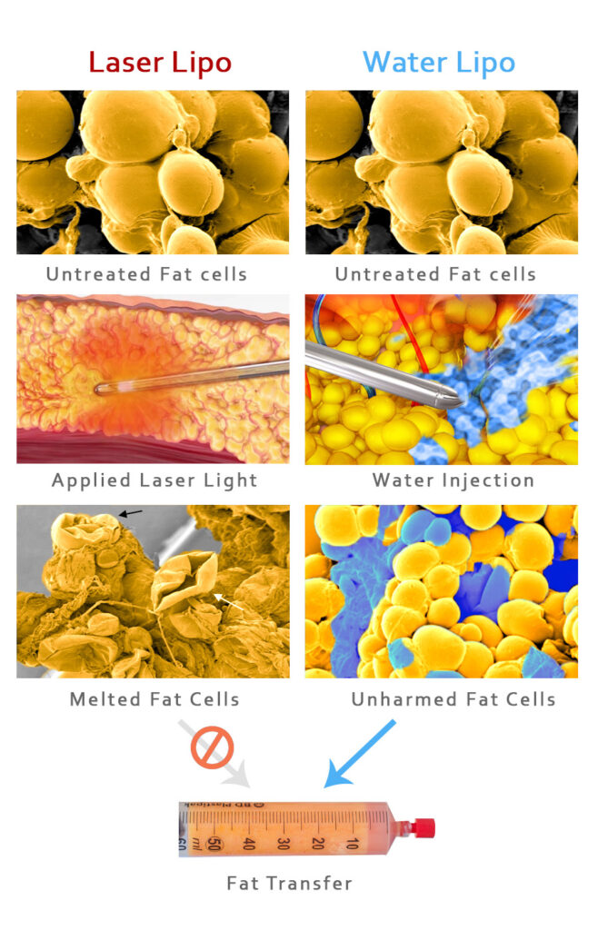 Differences between Laser Assisted and Water Assisted Liposuction. Melting vs Dislodging Fat Cells.