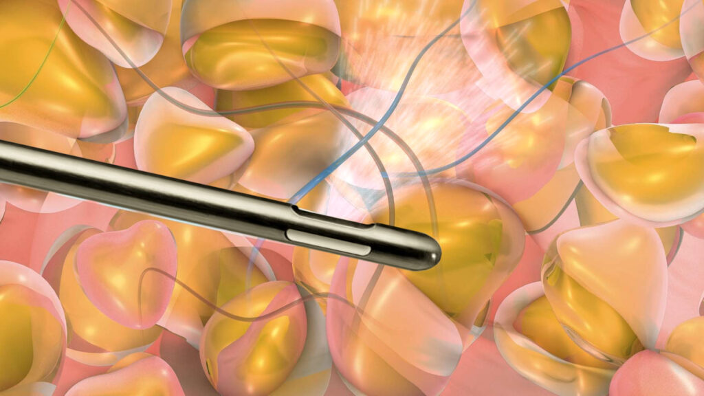 Cannula tip - water pressure essentially dislodges fat.